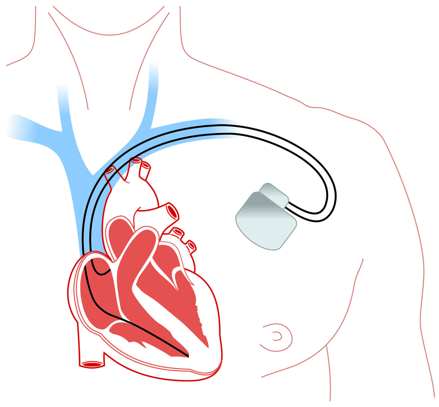 Pacemaker and Defibrillator Monitoring Springfield Arlington VA