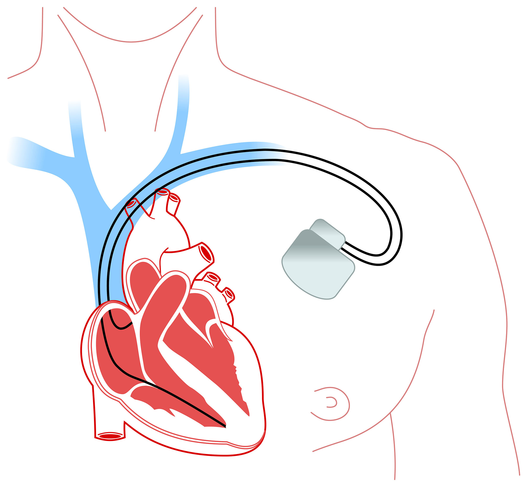 Pacemaker-defibrillator-monitoring