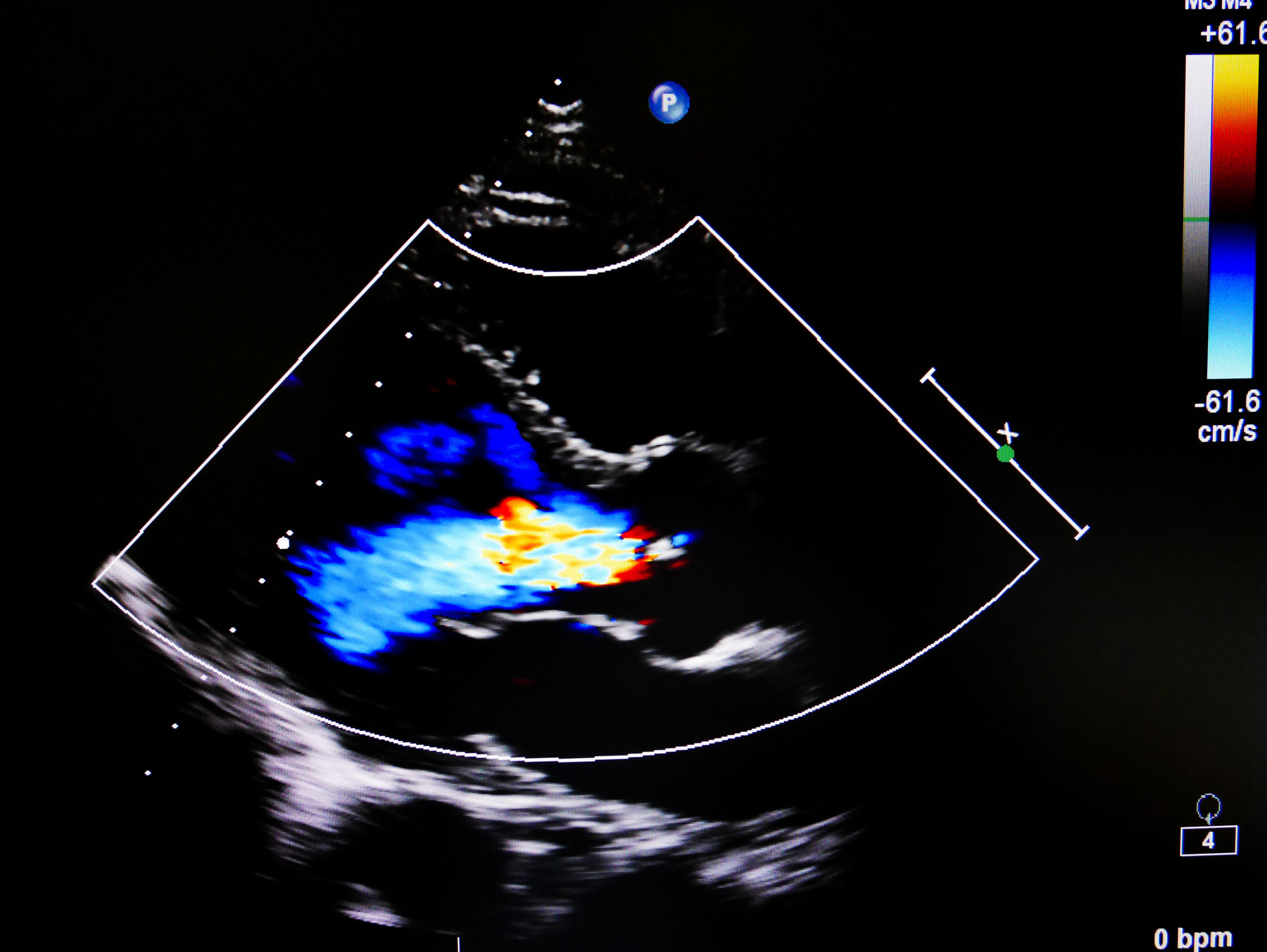 echocardiogram