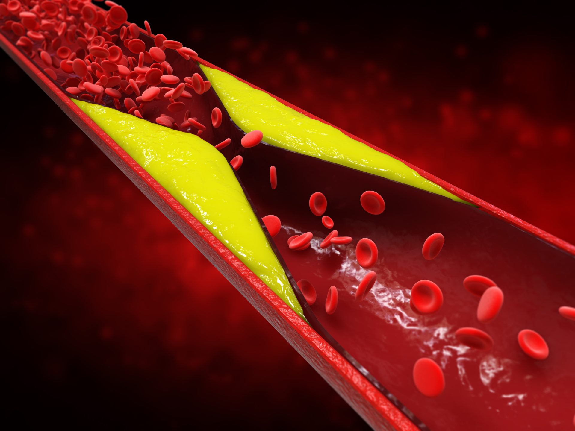 3d rendering atherosclerosis with cholesterol blood or plaque in vessel cause of coronary artery disease